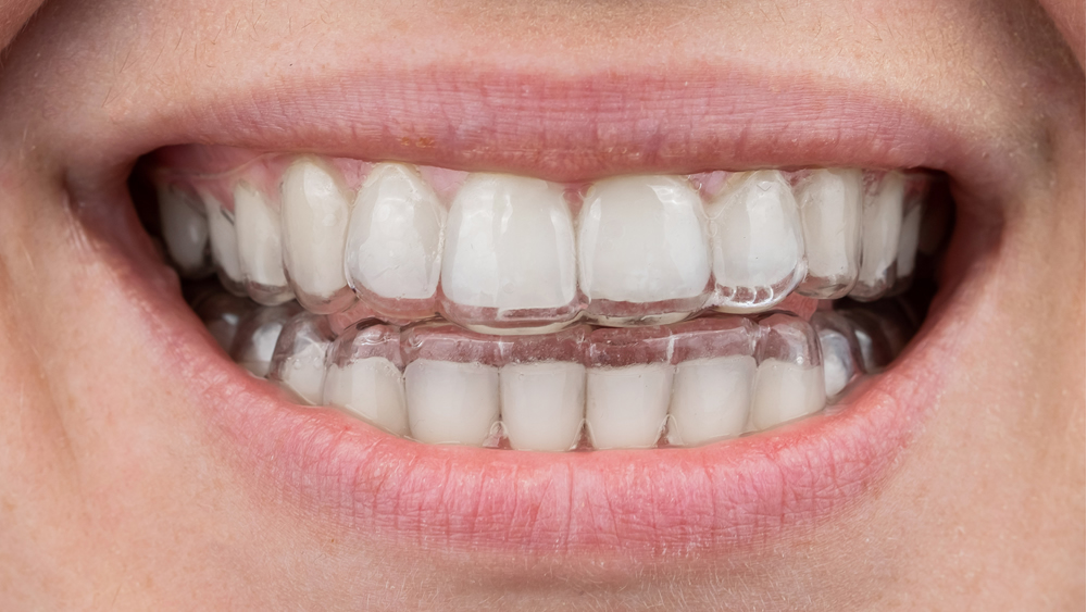 Alinhador Invisível